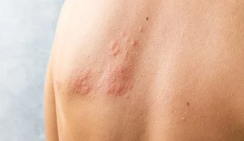 Ministério da Saúde não vai incluir vacina contra herpes-zóster no SUS