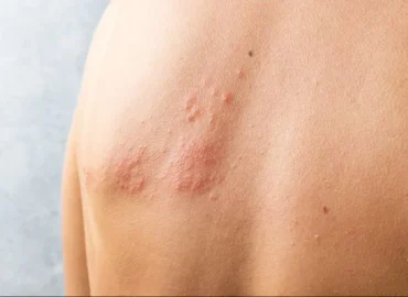 Ministério da Saúde não vai incluir vacina contra herpes-zóster no SUS