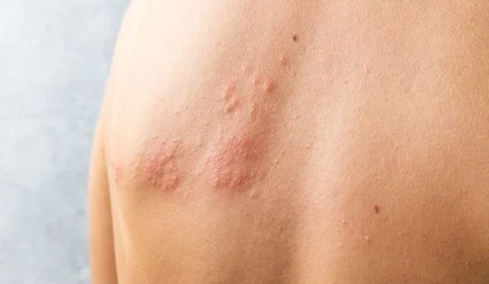 Ministério da Saúde não vai incluir vacina contra herpes-zóster no SUS